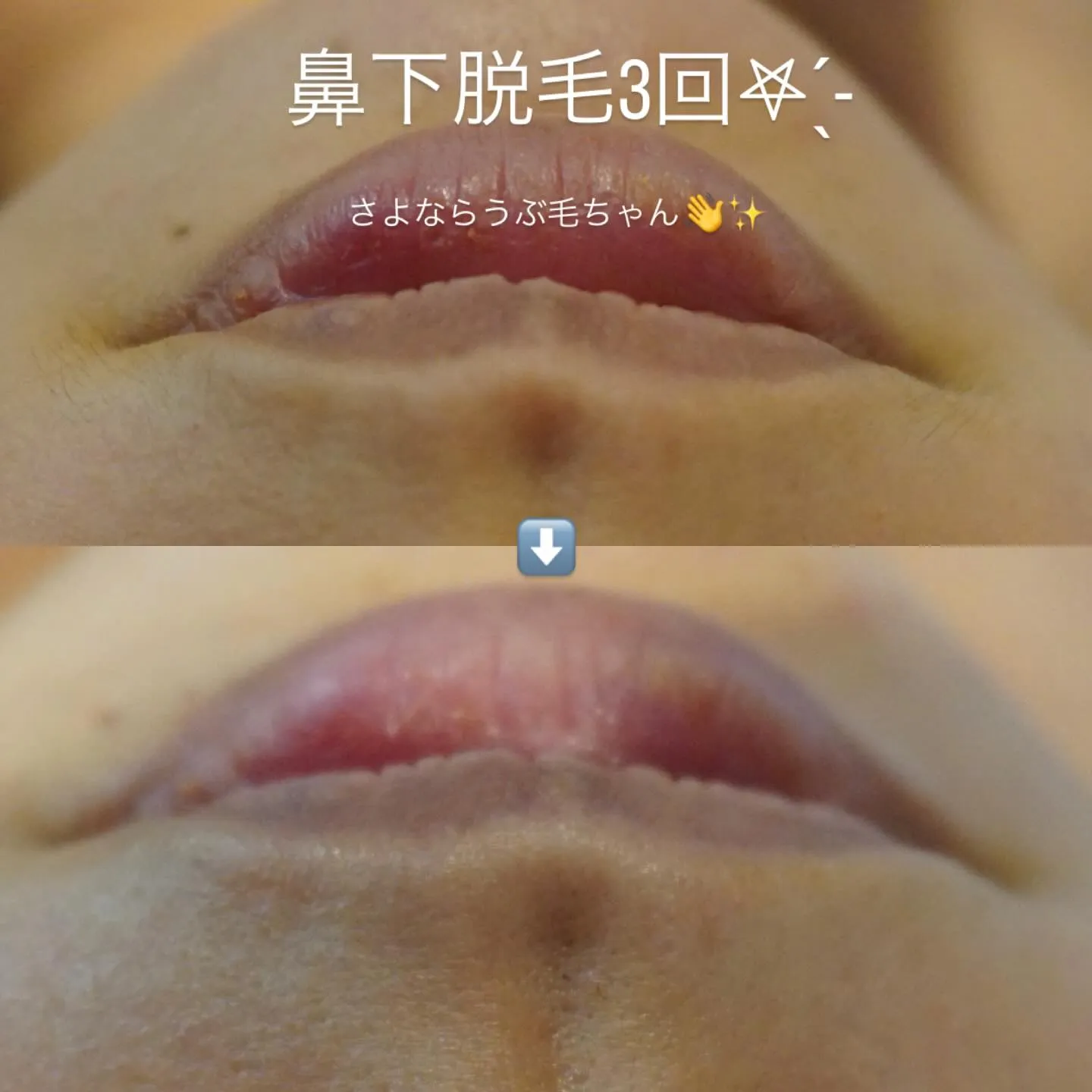 お顔脱毛✨