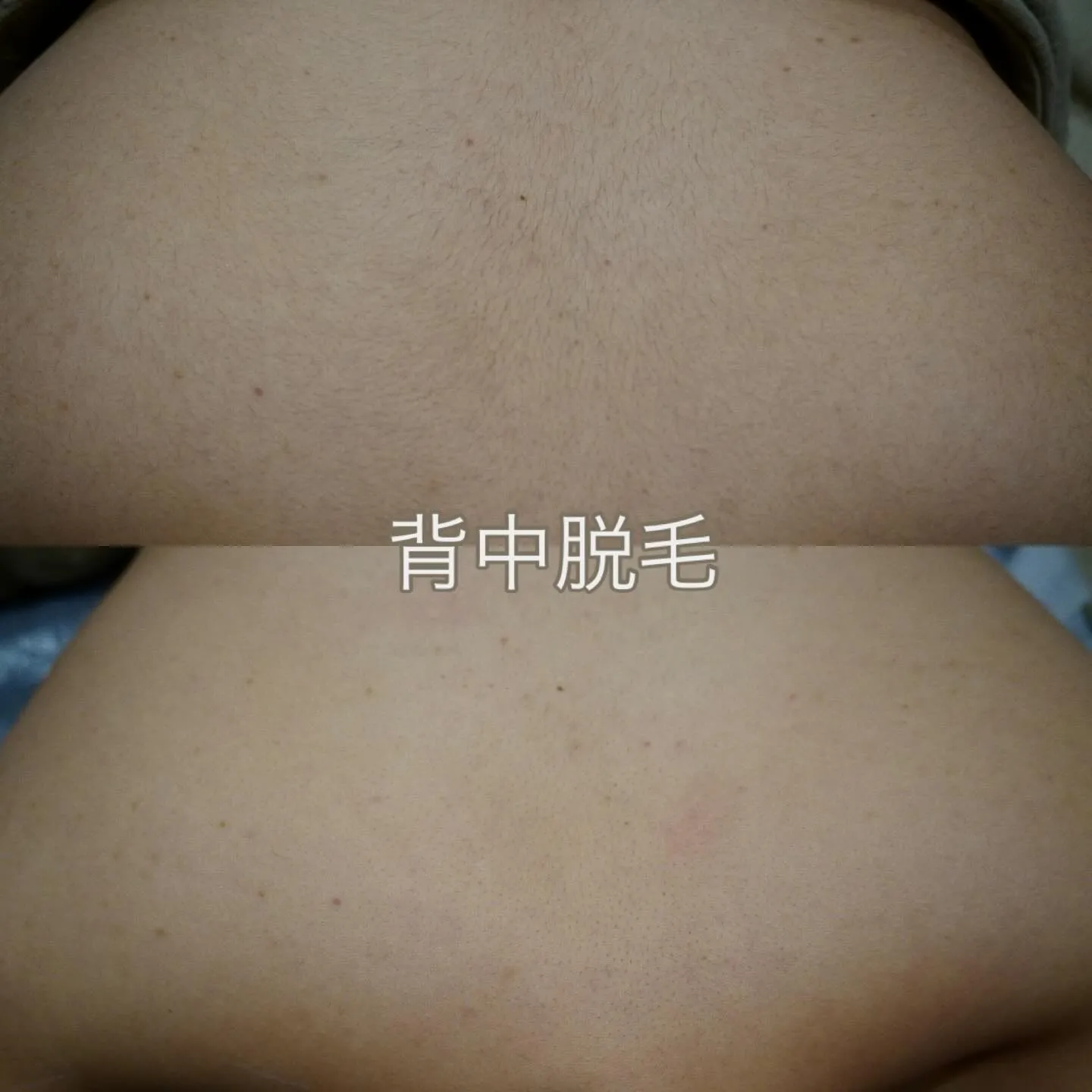 背中脱毛✩.*˚