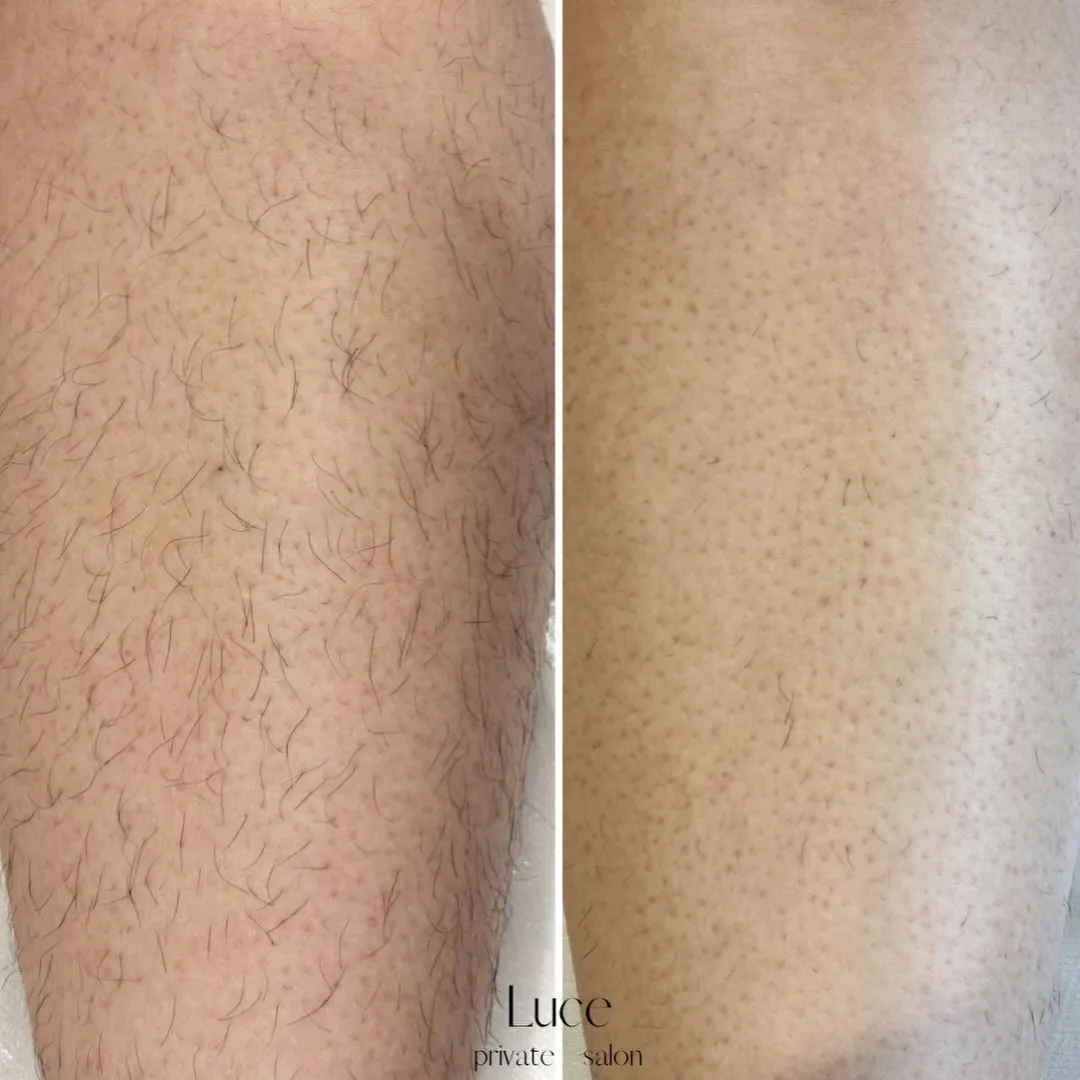 脚脱毛1回目 → 1ヶ月後の変化✨️