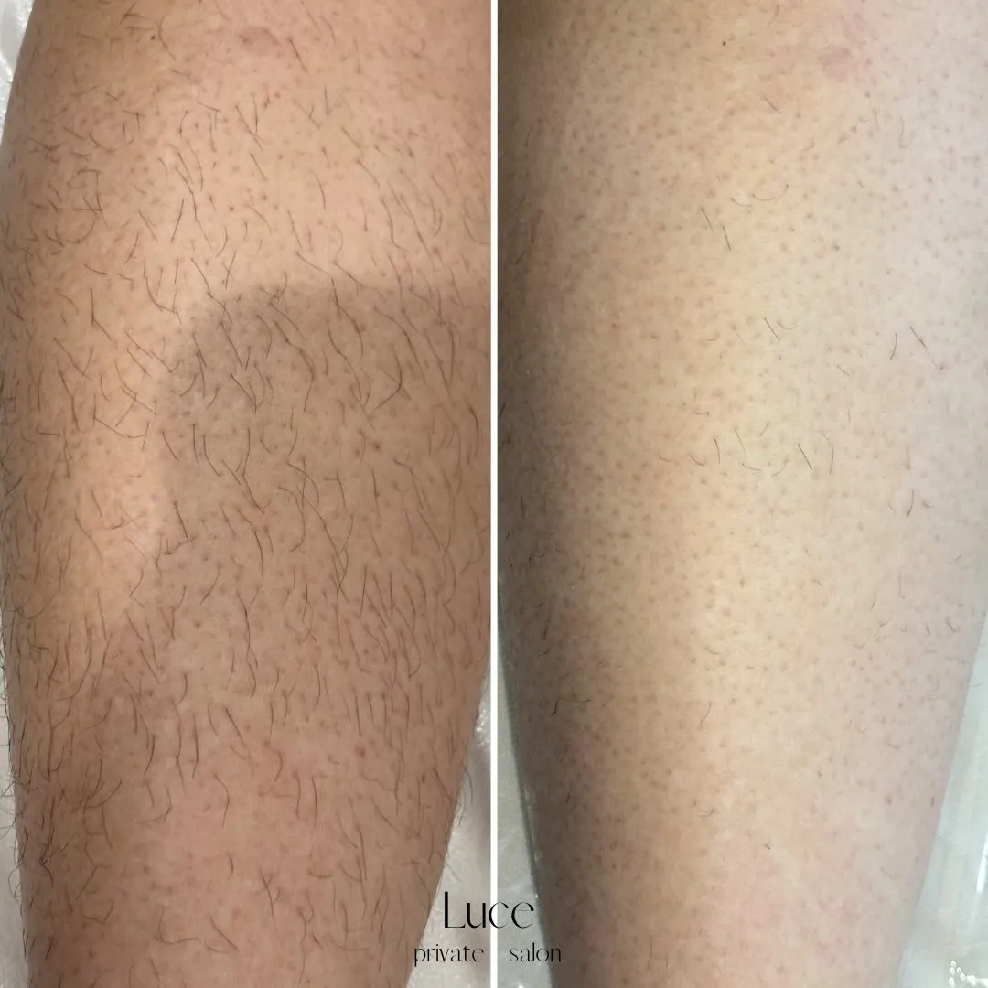 脚脱毛1回目 → 1ヶ月後の変化✨️