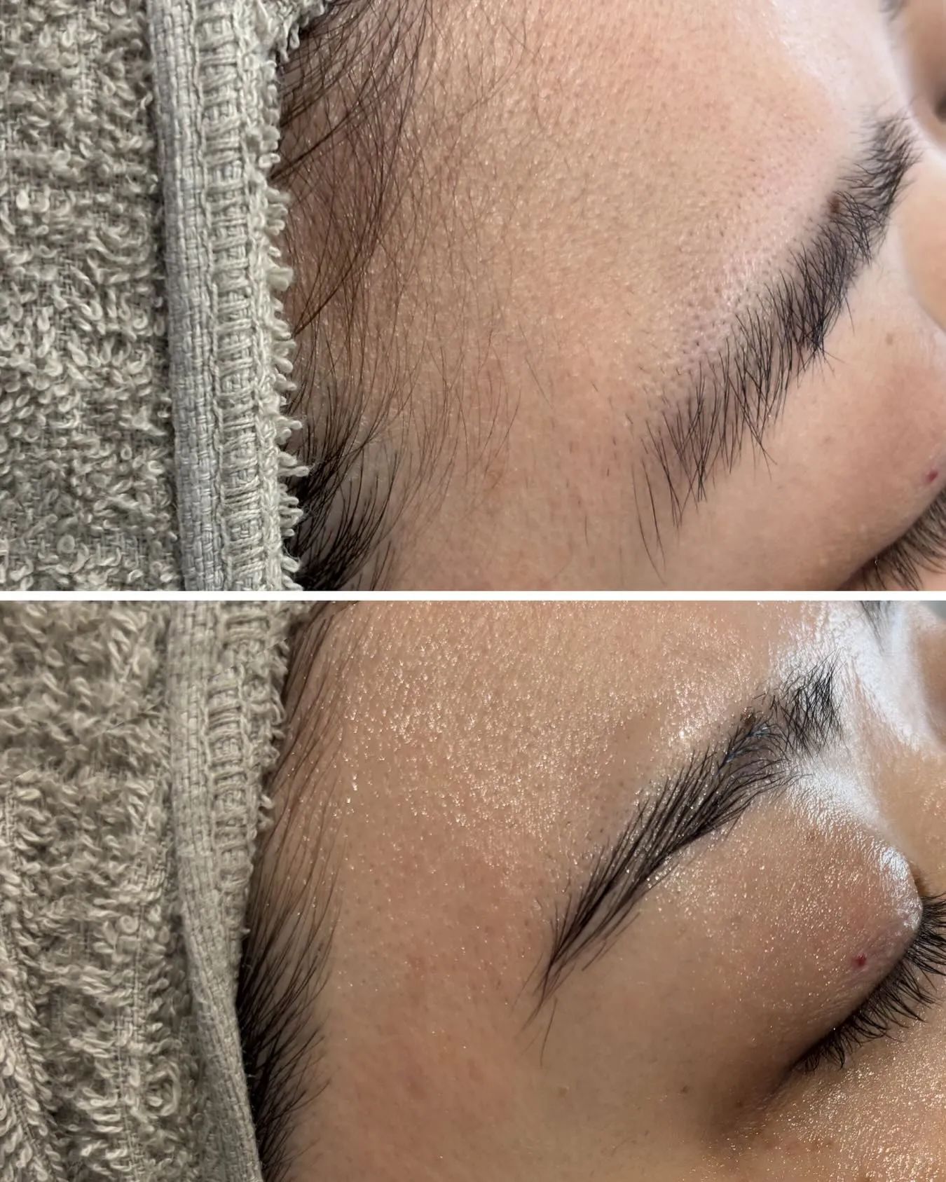 お顔脱毛🌿.∘