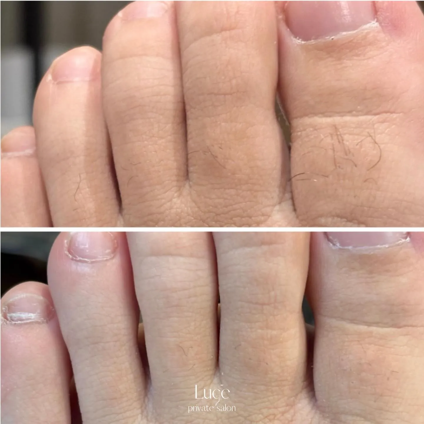 足の指毛さん🫣