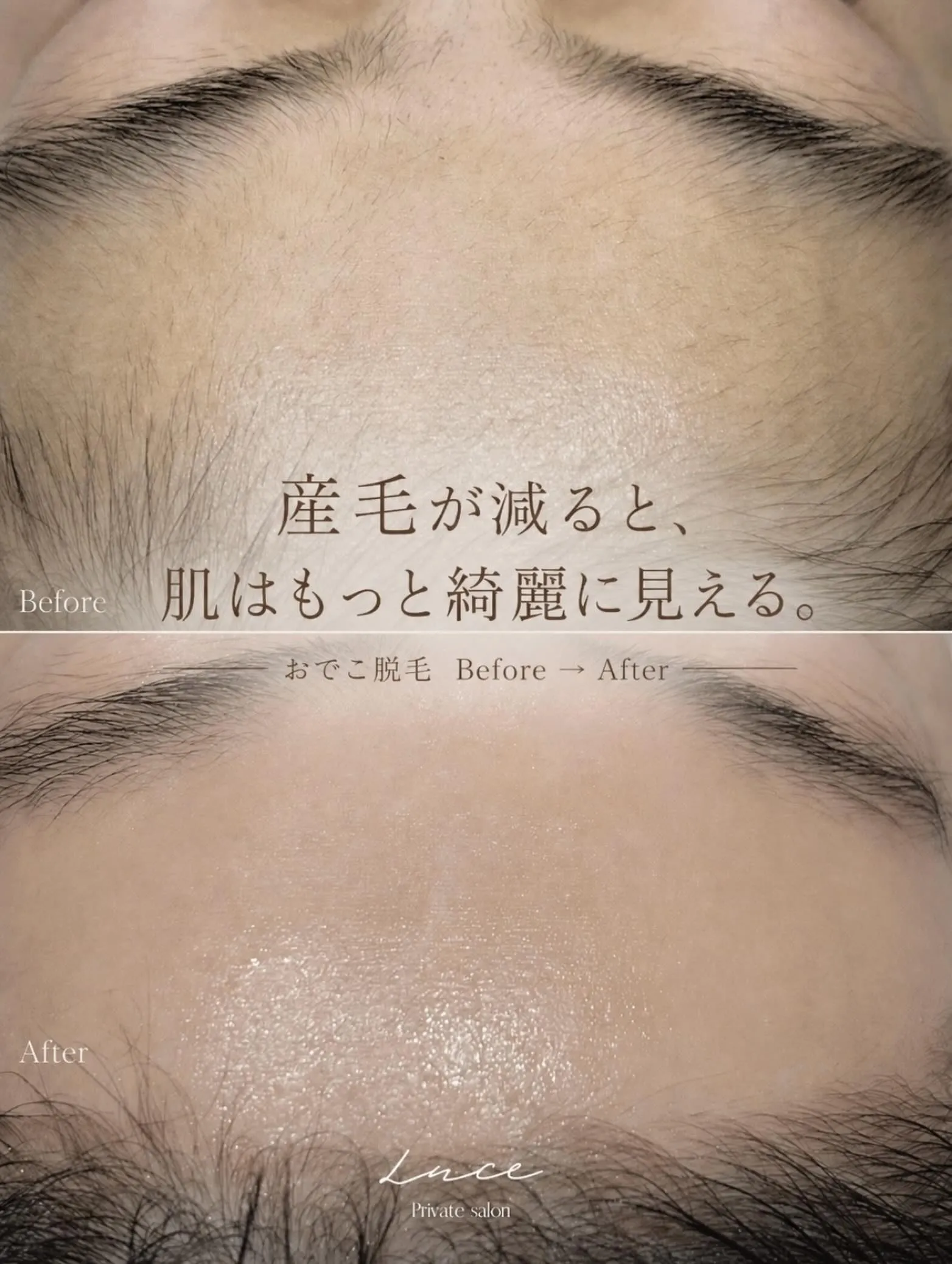 顔脱毛は「毛をなくすため」だけだと思っていませんか?☺️