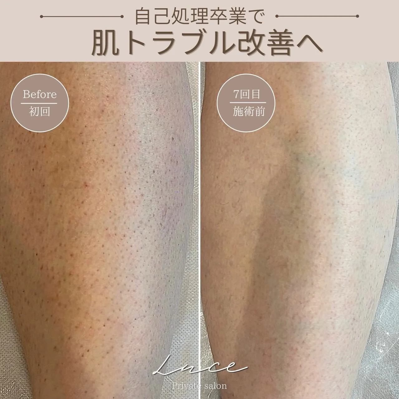 自己処理、続けるほどお肌に負担をかけているかもしれません💭