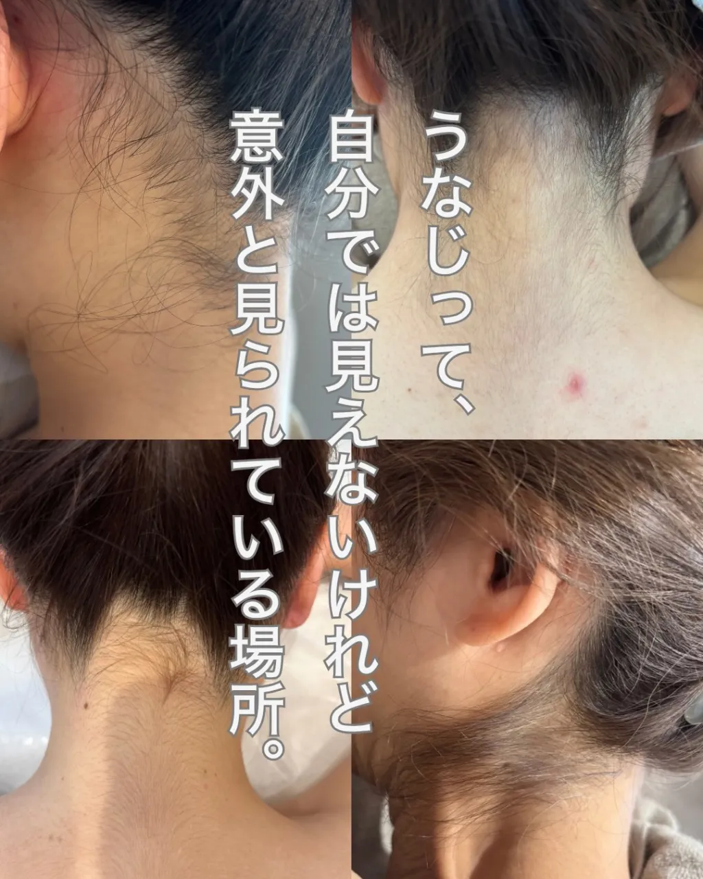うなじ脱毛、するなら気になった今♡