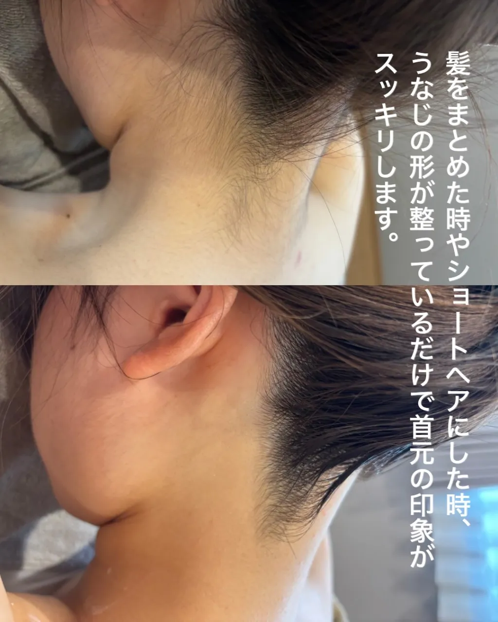 うなじ脱毛、するなら気になった今♡