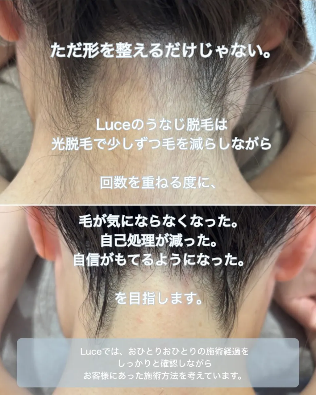 うなじ脱毛、するなら気になった今♡