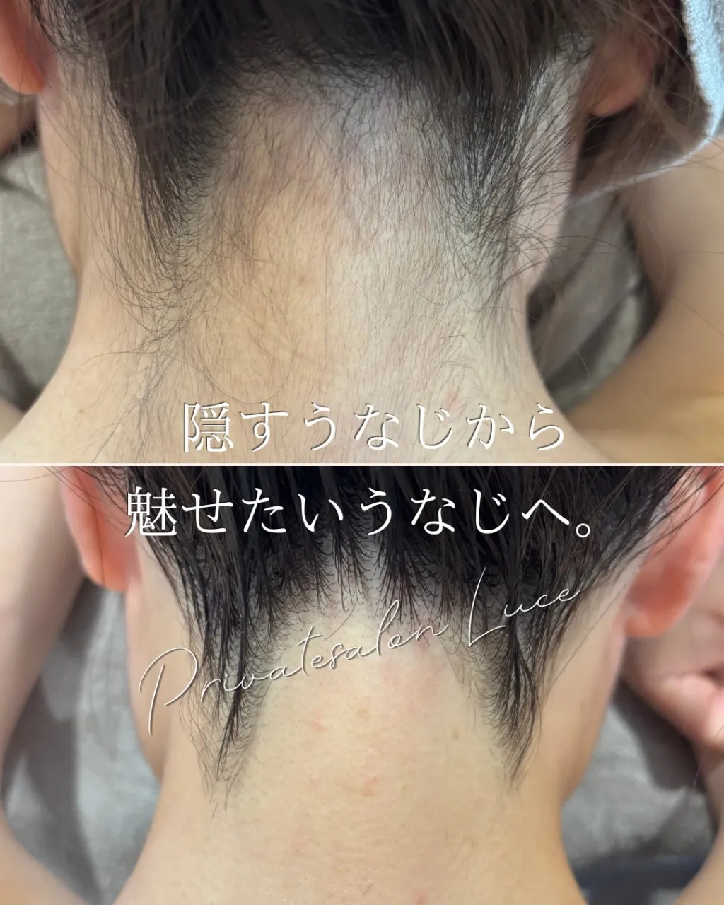 うなじ脱毛、するなら気になった今♡