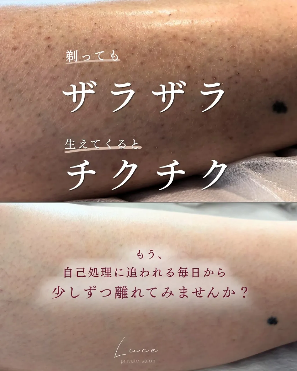 「剃ってもザラザラする」