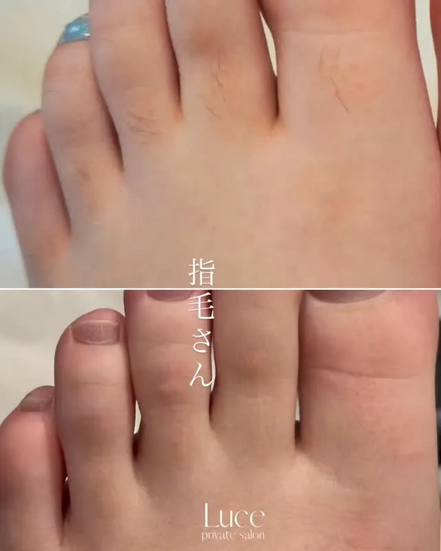 脱毛施術4回目のお客様です👏🏻